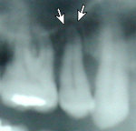x-ray abscess tooth