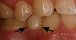 Dental Implant Restoration with Peyman Chris Fattahi DDS near Cincinnati OH
