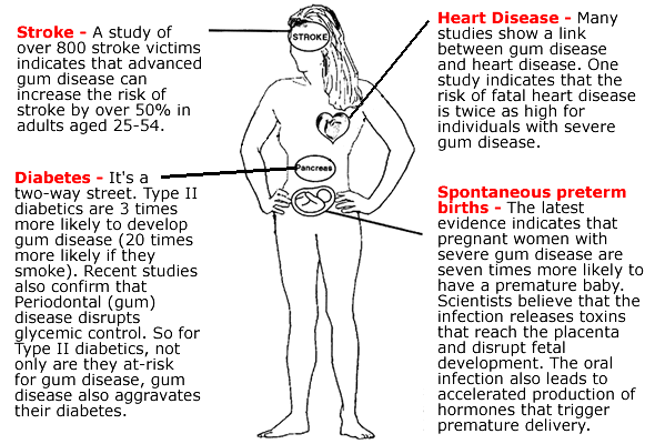 diagram of Gum Disease dangers